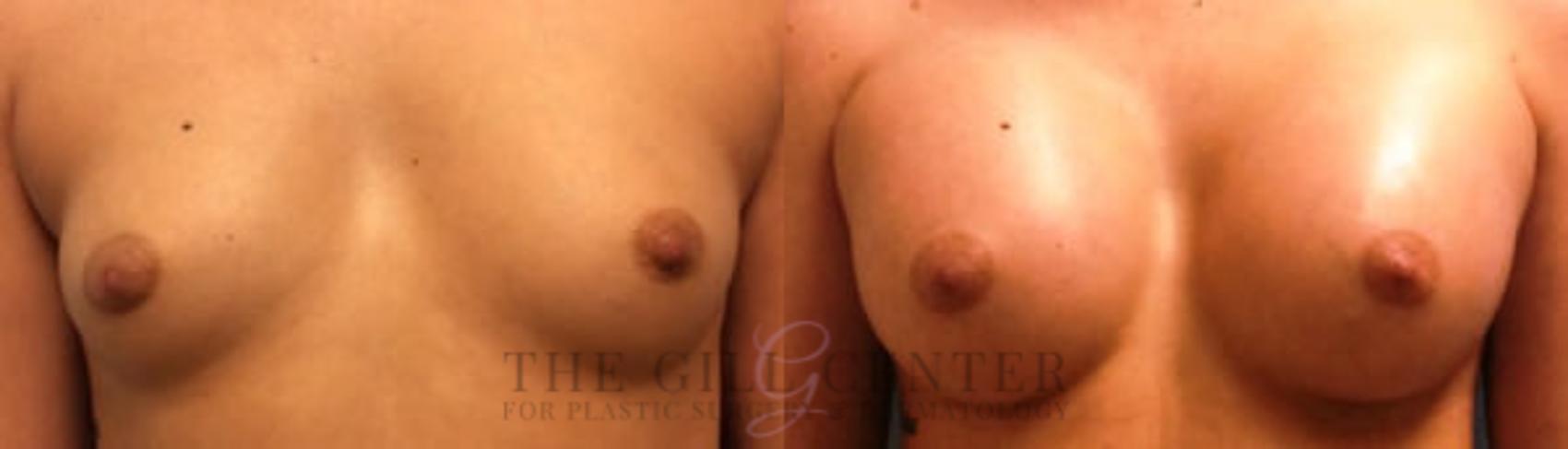 Breast Augmentation Case 45 Before & After Front | The Woodlands, TX | The Gill Center for Plastic Surgery and Dermatology