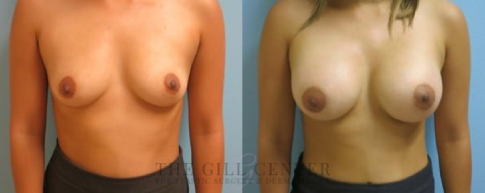 Breast Augmentation Case 46 Before & After Front | The Woodlands, TX | The Gill Center for Plastic Surgery and Dermatology