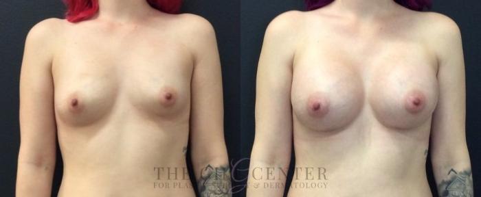 Breast Augmentation Case 461 Before & After Front | The Woodlands, TX | The Gill Center for Plastic Surgery and Dermatology
