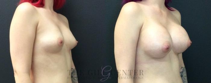 Breast Augmentation Case 461 Before & After Right Oblique | The Woodlands, TX | The Gill Center for Plastic Surgery and Dermatology
