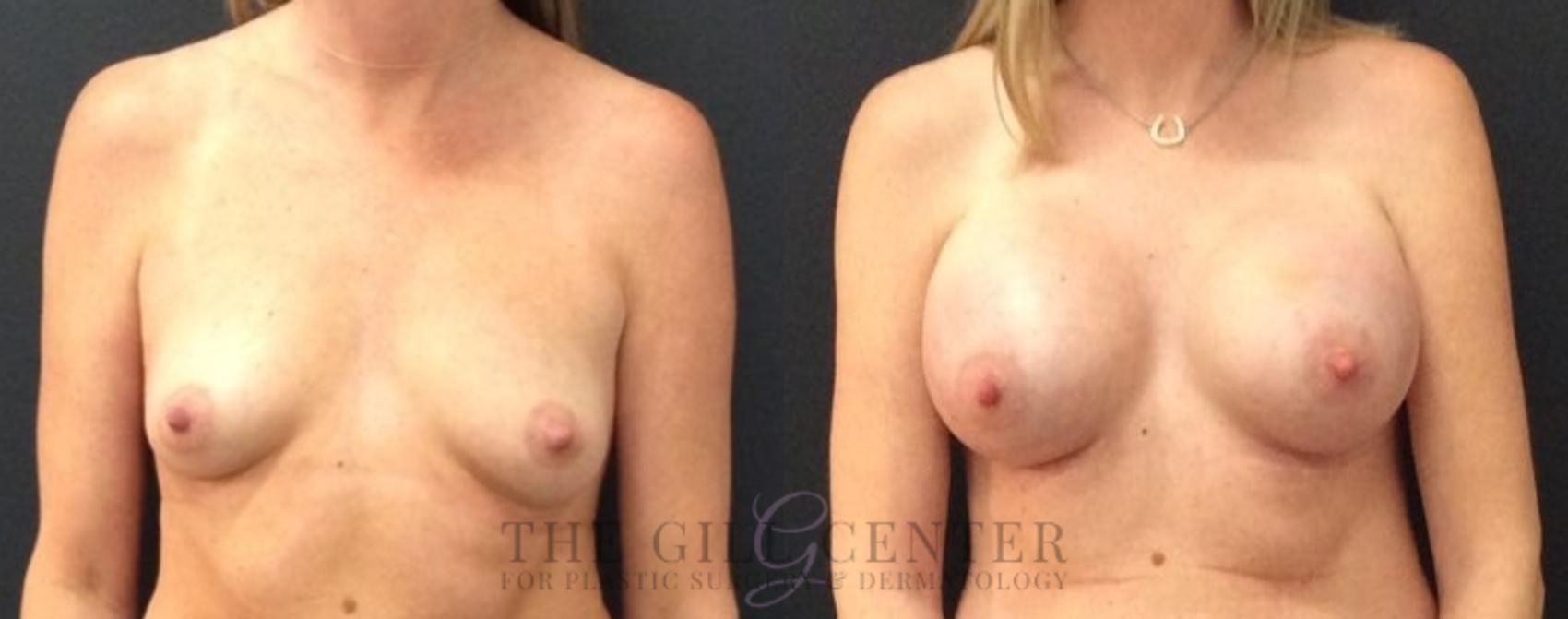 Breast Augmentation Case 462 Before & After Front | The Woodlands, TX | The Gill Center for Plastic Surgery and Dermatology