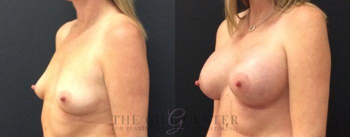 Breast Augmentation Case 462 Before & After Left Oblique | The Woodlands, TX | The Gill Center for Plastic Surgery and Dermatology