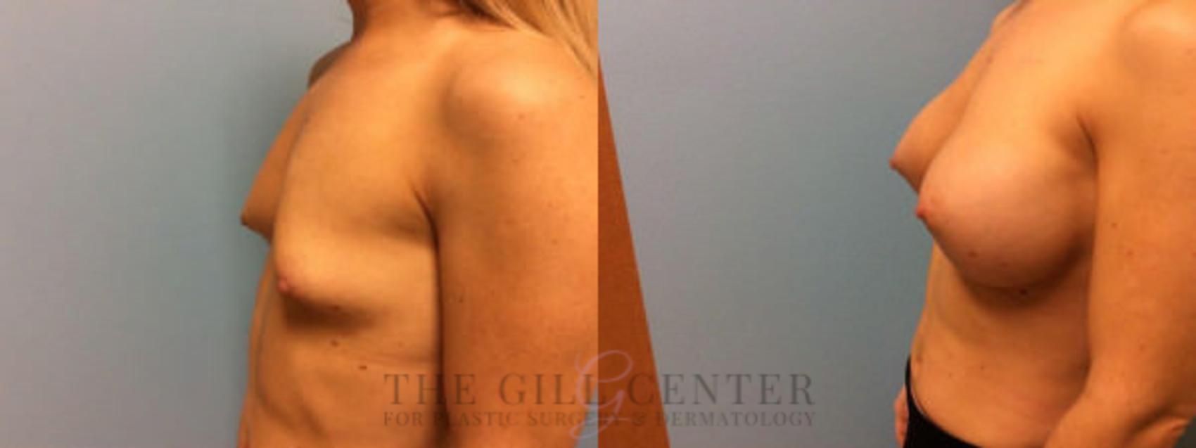 Breast Augmentation Case 47 Before & After Left Side | The Woodlands, TX | The Gill Center for Plastic Surgery and Dermatology