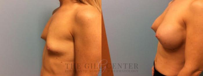 Breast Augmentation Case 47 Before & After Left Side | The Woodlands, TX | The Gill Center for Plastic Surgery and Dermatology