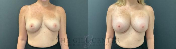 Breast Augmentation Case 470 Before & After Front | The Woodlands, TX | The Gill Center for Plastic Surgery and Dermatology
