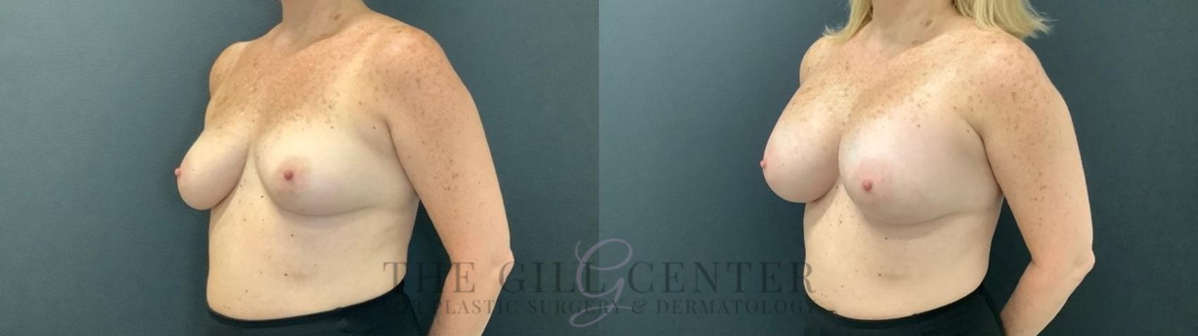 Breast Augmentation Case 470 Before & After Left Oblique | The Woodlands, TX | The Gill Center for Plastic Surgery and Dermatology