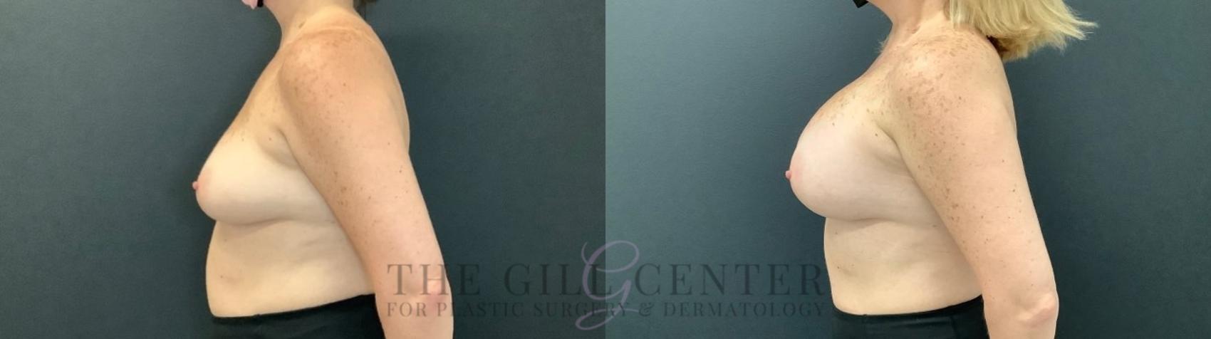 Breast Augmentation Case 470 Before & After Left Side | The Woodlands, TX | The Gill Center for Plastic Surgery and Dermatology