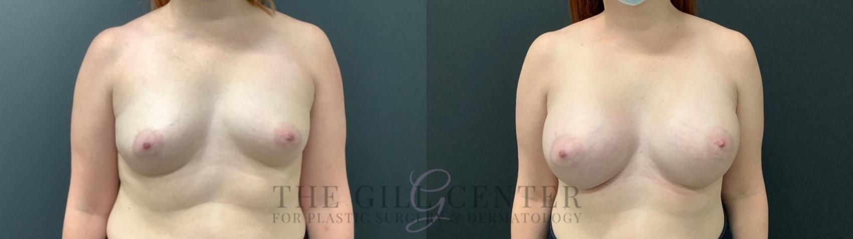 Breast Augmentation Case 475 Before & After Front | The Woodlands, TX | The Gill Center for Plastic Surgery and Dermatology