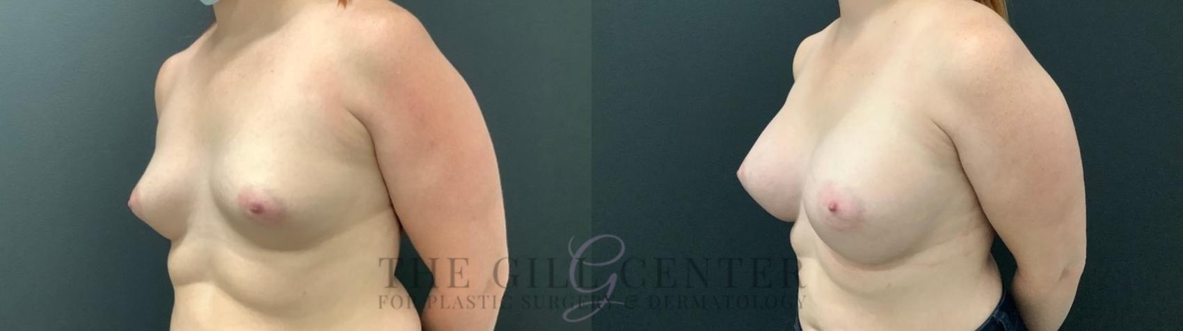 Breast Augmentation Case 475 Before & After Left Oblique | The Woodlands, TX | The Gill Center for Plastic Surgery and Dermatology