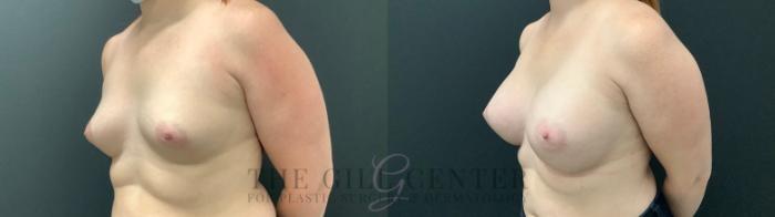 Breast Augmentation Case 475 Before & After Left Oblique | The Woodlands, TX | The Gill Center for Plastic Surgery and Dermatology