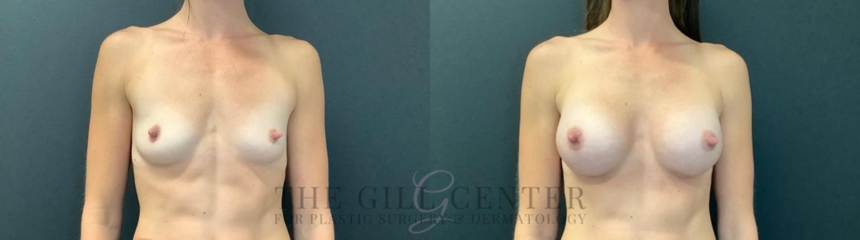 Breast Augmentation Case 477 Before & After Front | The Woodlands, TX | The Gill Center for Plastic Surgery and Dermatology