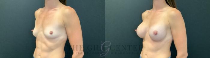 Breast Augmentation Case 477 Before & After Left Oblique | The Woodlands, TX | The Gill Center for Plastic Surgery and Dermatology