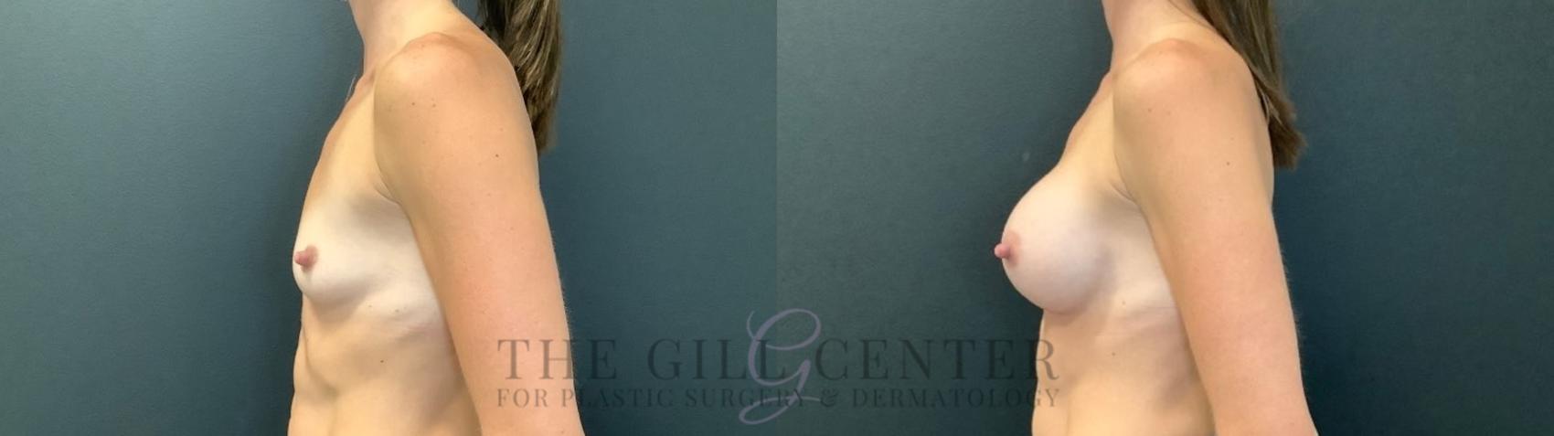 Breast Augmentation Case 477 Before & After Left Side | The Woodlands, TX | The Gill Center for Plastic Surgery and Dermatology