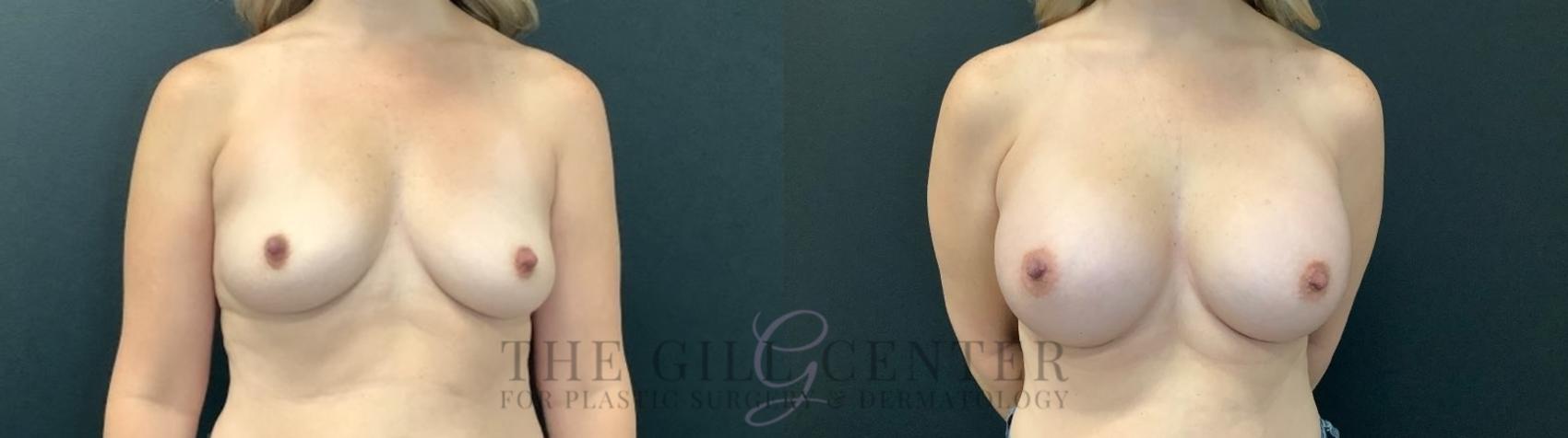 Breast Augmentation Case 482 Before & After Front | The Woodlands, TX | The Gill Center for Plastic Surgery and Dermatology