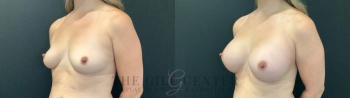 Breast Augmentation Case 482 Before & After Left Oblique | The Woodlands, TX | The Gill Center for Plastic Surgery and Dermatology