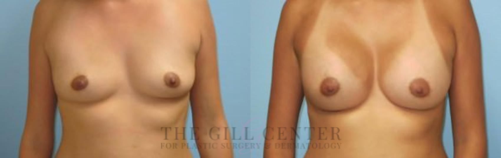 Breast Augmentation Case 49 Before & After Front | The Woodlands, TX | The Gill Center for Plastic Surgery and Dermatology