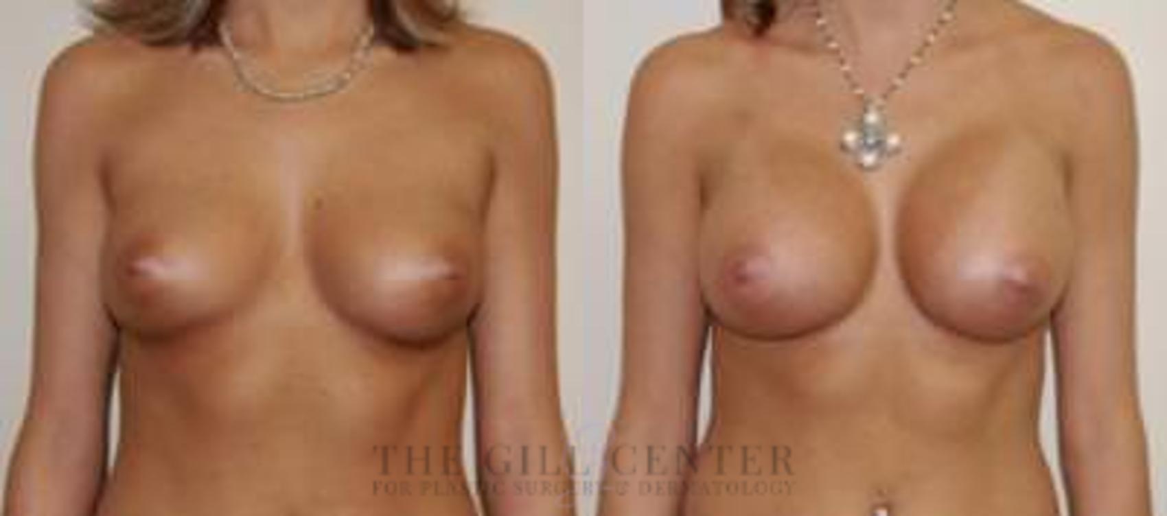 Breast Augmentation Case 50 Before & After Front | The Woodlands, TX | The Gill Center for Plastic Surgery and Dermatology