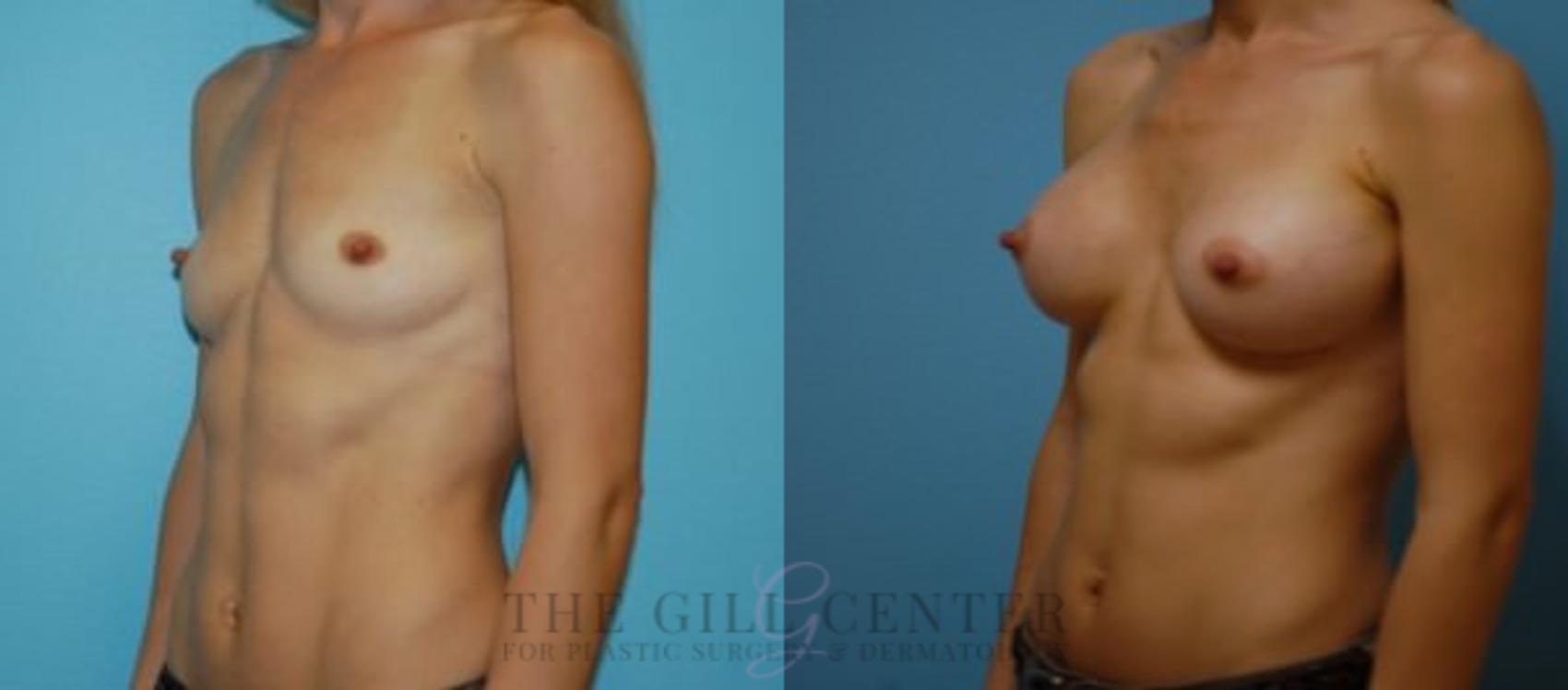 Breast Augmentation Case 51 Before & After Left Oblique | The Woodlands, TX | The Gill Center for Plastic Surgery and Dermatology