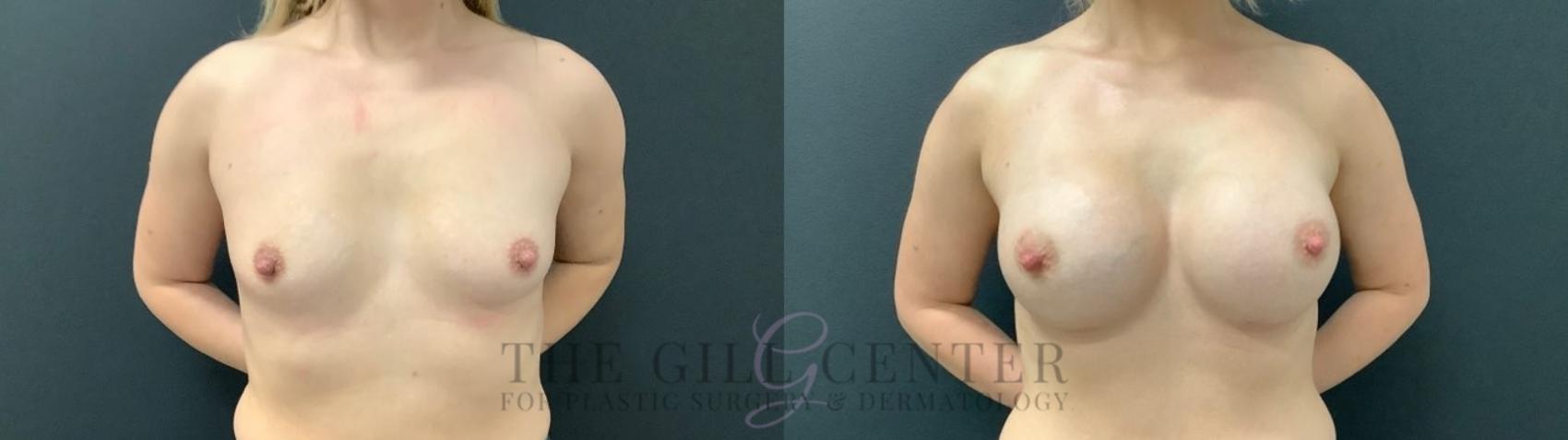 Breast Augmentation Case 519 Before & After Front | The Woodlands, TX | The Gill Center for Plastic Surgery and Dermatology