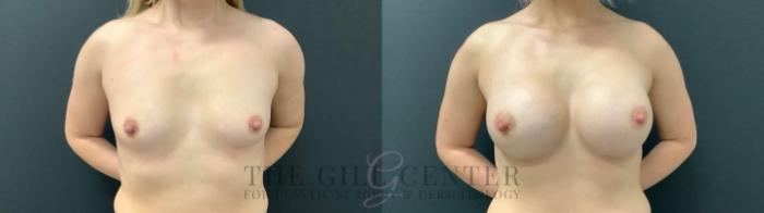 Breast Augmentation Case 519 Before & After Front | The Woodlands, TX | The Gill Center for Plastic Surgery and Dermatology