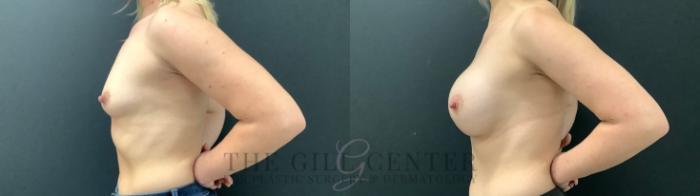 Breast Augmentation Case 519 Before & After Left Side | The Woodlands, TX | The Gill Center for Plastic Surgery and Dermatology