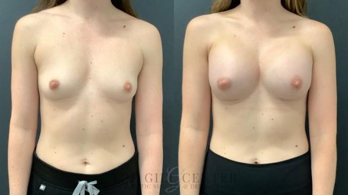 Breast Augmentation Case 525 Before & After Front | The Woodlands, TX | The Gill Center for Plastic Surgery and Dermatology