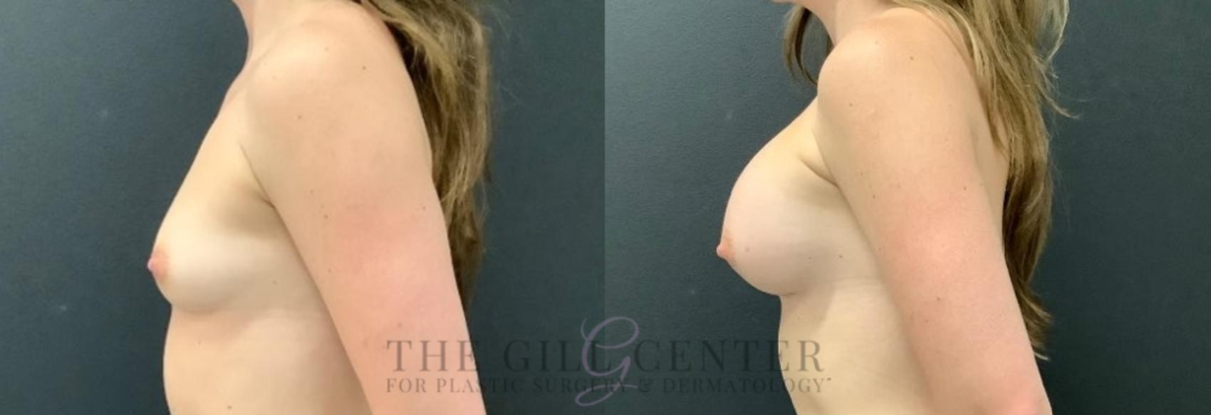 Breast Augmentation Case 525 Before & After Left Side | The Woodlands, TX | The Gill Center for Plastic Surgery and Dermatology