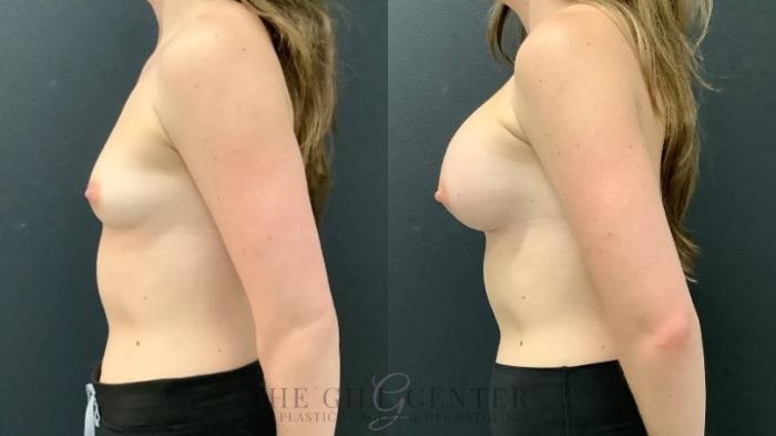 Breast Augmentation Case 525 Before & After Left Side | The Woodlands, TX | The Gill Center for Plastic Surgery and Dermatology