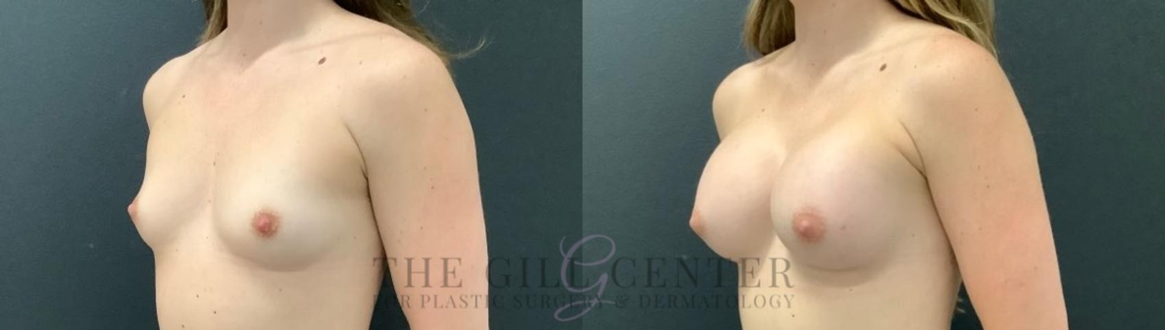 Breast Augmentation Case 525 Before & After Left Three-quarter view | The Woodlands, TX | The Gill Center for Plastic Surgery and Dermatology
