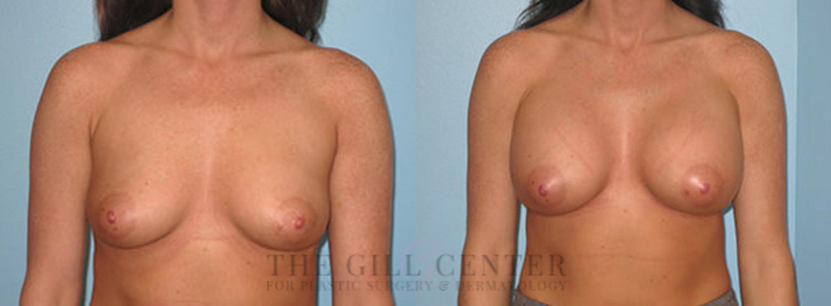 Breast Augmentation Case 54 Before & After Front | The Woodlands, TX | The Gill Center for Plastic Surgery and Dermatology