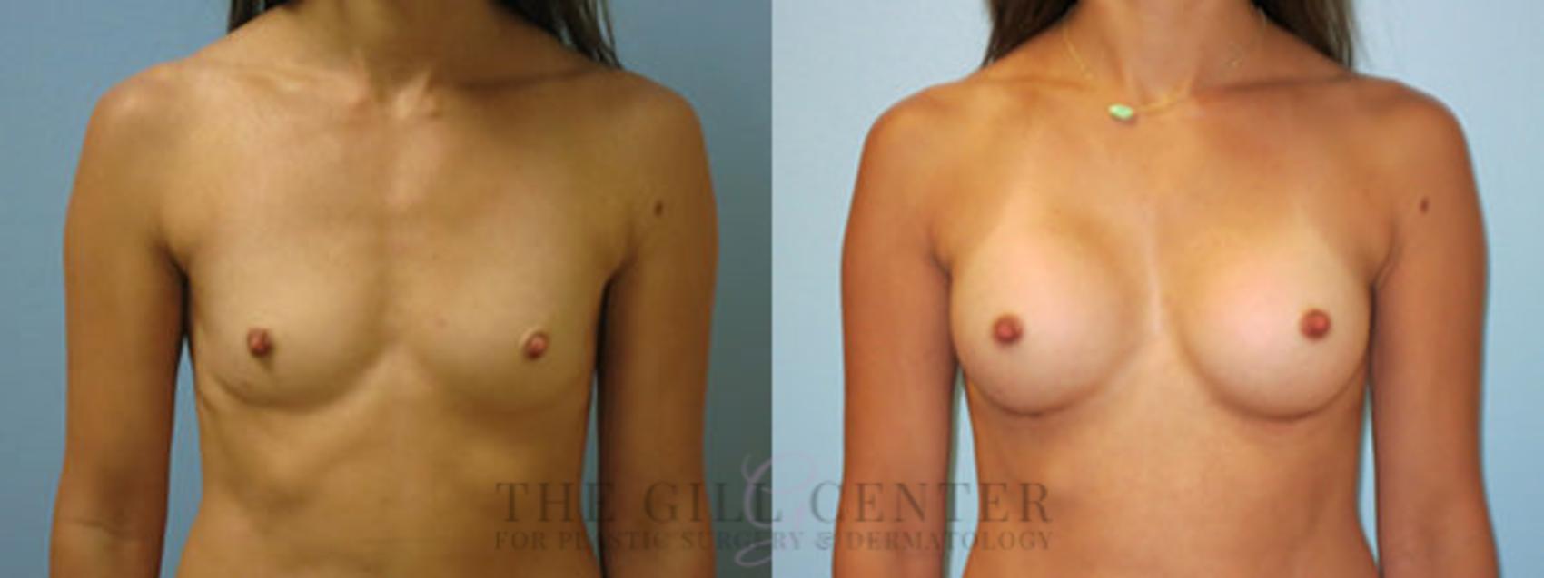 Breast Augmentation Case 55 Before & After Front | The Woodlands, TX | The Gill Center for Plastic Surgery and Dermatology