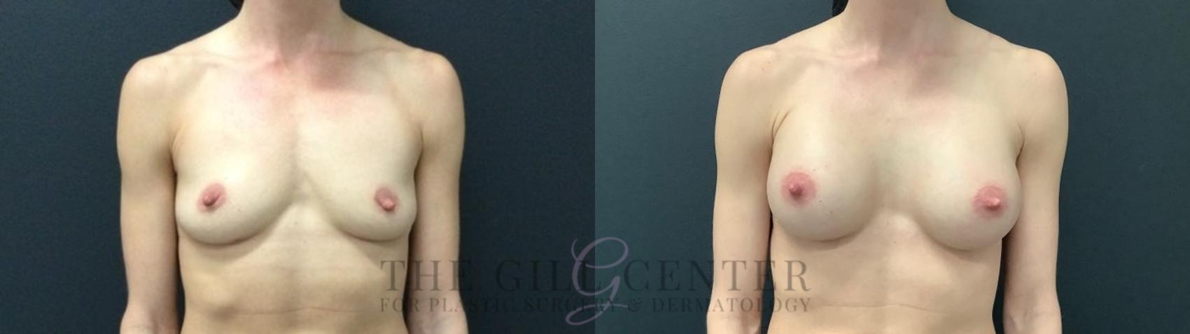 Breast Augmentation Case 552 Before & After Front | The Woodlands, TX | The Gill Center for Plastic Surgery and Dermatology