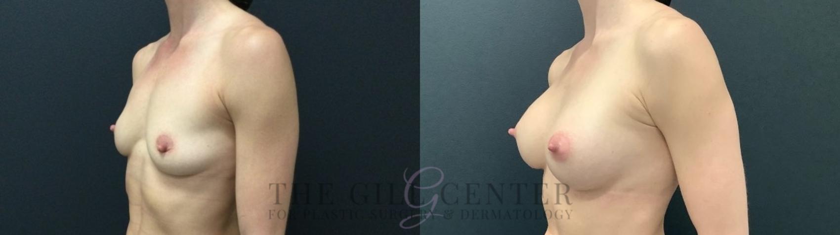Breast Augmentation Case 552 Before & After Left Oblique | The Woodlands, TX | The Gill Center for Plastic Surgery and Dermatology