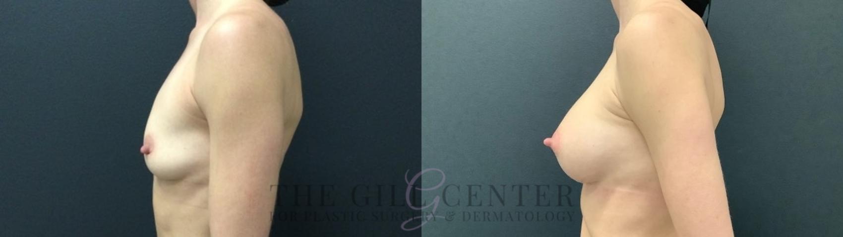 Breast Augmentation Case 552 Before & After Left Side | The Woodlands, TX | The Gill Center for Plastic Surgery and Dermatology