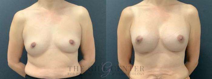 Breast Augmentation Case 557 Before & After Front | The Woodlands, TX | The Gill Center for Plastic Surgery and Dermatology