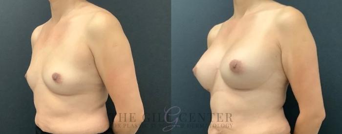 Breast Augmentation Case 557 Before & After Left Oblique | The Woodlands, TX | The Gill Center for Plastic Surgery and Dermatology