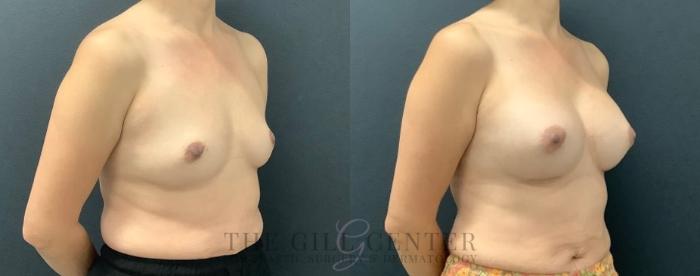 Breast Augmentation Case 557 Before & After Right Side | The Woodlands, TX | The Gill Center for Plastic Surgery and Dermatology