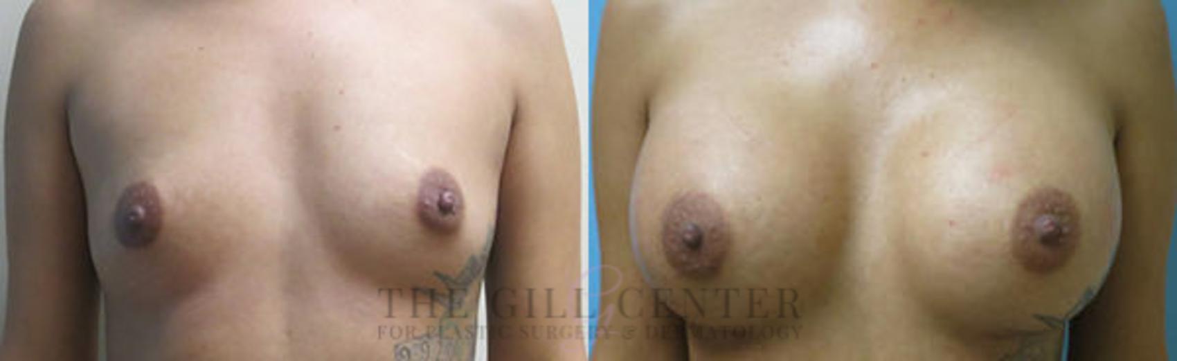 Breast Augmentation Case 56 Before & After Front | The Woodlands, TX | The Gill Center for Plastic Surgery and Dermatology