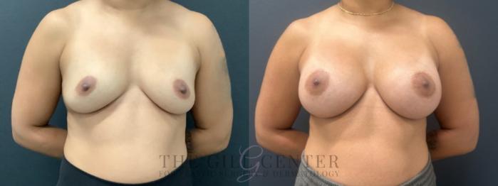 Breast Augmentation Case 570 Before & After Front | The Woodlands, TX | The Gill Center for Plastic Surgery and Dermatology