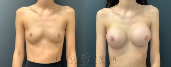 Breast Augmentation Case 578 Before & After Front | The Woodlands, TX | The Gill Center for Plastic Surgery and Dermatology