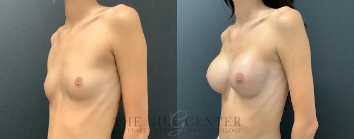 Breast Augmentation Case 578 Before & After Left Oblique | The Woodlands, TX | The Gill Center for Plastic Surgery and Dermatology