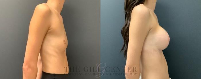 Breast Augmentation Case 578 Before & After Right Side | The Woodlands, TX | The Gill Center for Plastic Surgery and Dermatology