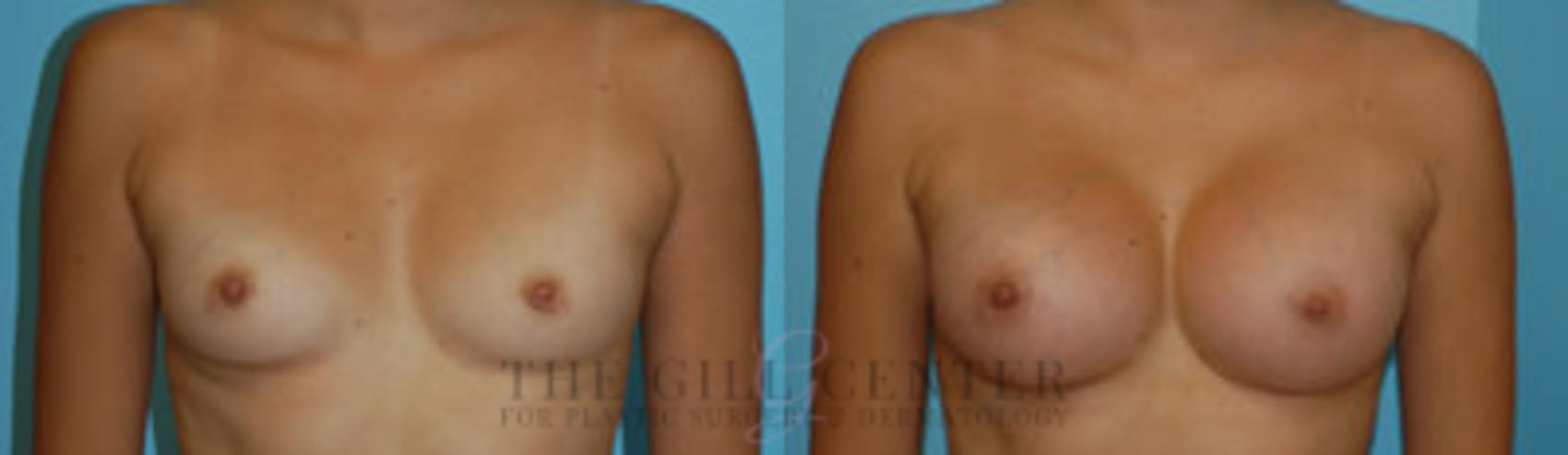 Breast Augmentation Case 58 Before & After Front | The Woodlands, TX | The Gill Center for Plastic Surgery and Dermatology