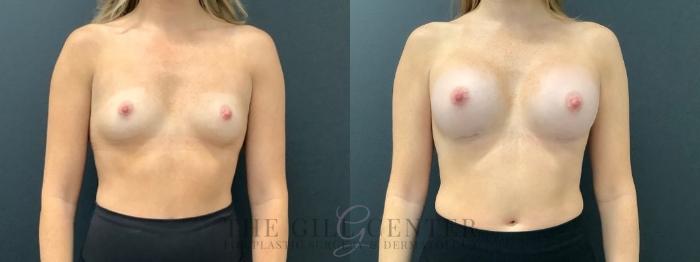 Breast Augmentation Case 586 Before & After Front | The Woodlands, TX | The Gill Center for Plastic Surgery and Dermatology