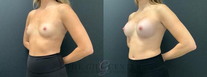 Breast Augmentation Case 586 Before & After Left Oblique | The Woodlands, TX | The Gill Center for Plastic Surgery and Dermatology