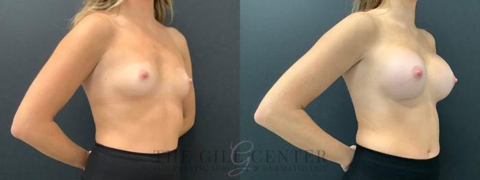 Breast Augmentation Case 586 Before & After Right Oblique | The Woodlands, TX | The Gill Center for Plastic Surgery and Dermatology