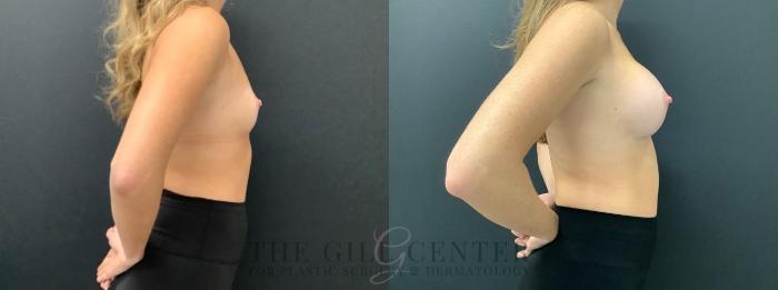 Breast Augmentation Case 586 Before & After Right Side | The Woodlands, TX | The Gill Center for Plastic Surgery and Dermatology
