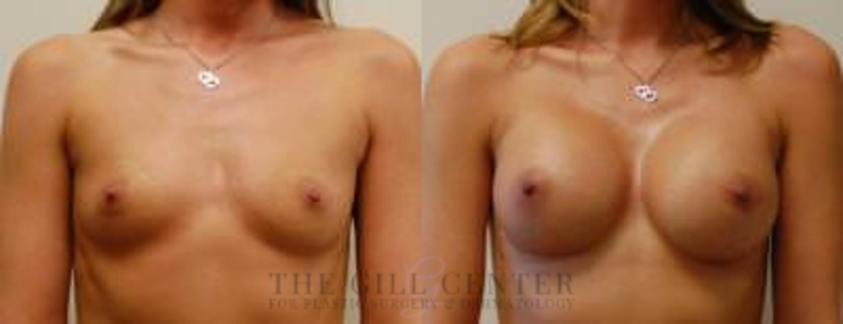 Breast Augmentation Case 59 Before & After Front | The Woodlands, TX | The Gill Center for Plastic Surgery and Dermatology