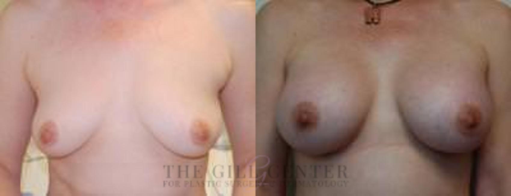 Breast Augmentation Case 60 Before & After Front | The Woodlands, TX | The Gill Center for Plastic Surgery and Dermatology