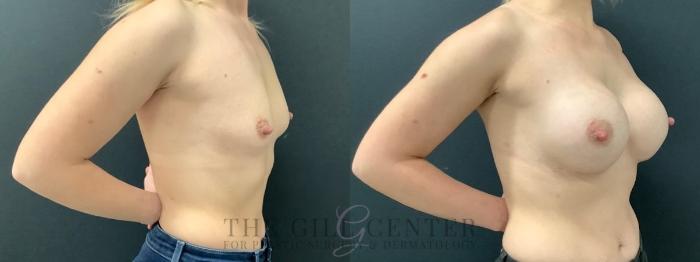 Breast Augmentation Case 600 Before & After Right Oblique | The Woodlands, TX | The Gill Center for Plastic Surgery and Dermatology